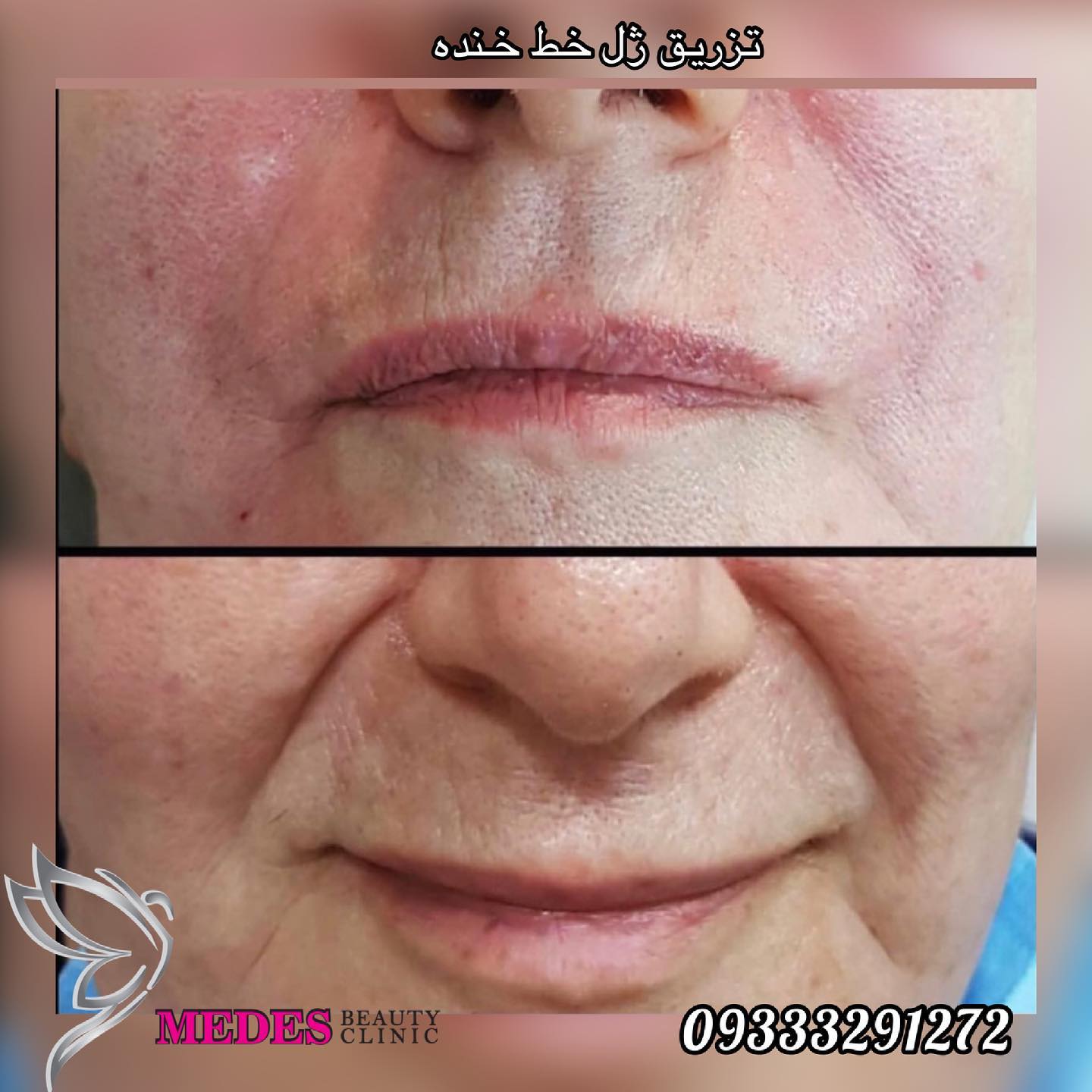 تزریق ژل خط خنده